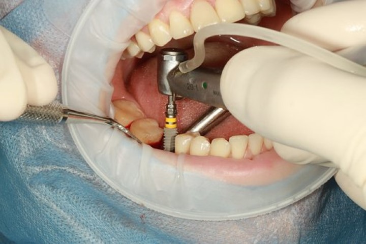 denture implants